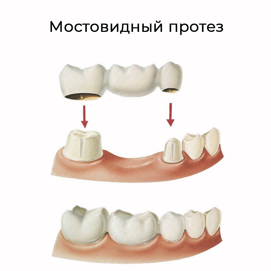 Сделать зубные протезы в Самаре в Ам Клиник - 28 февраля 2023 - 63.ру